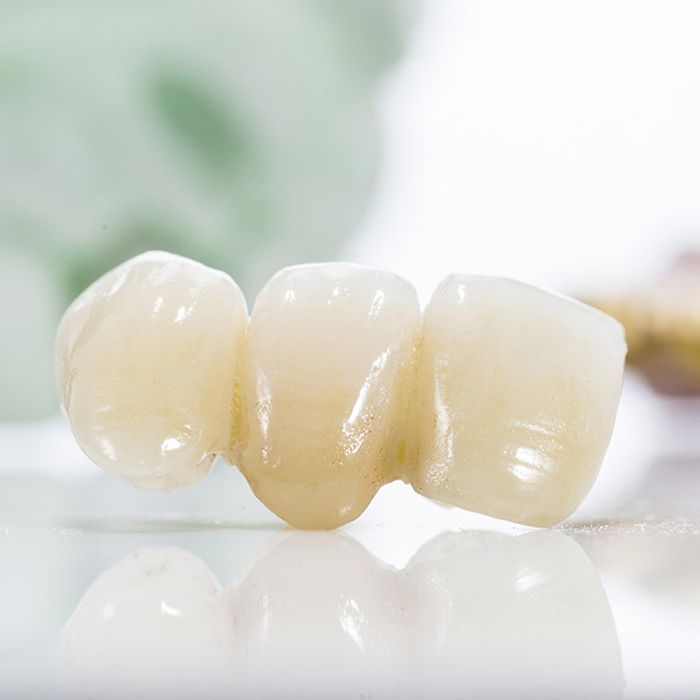 Close-up of dental bridge before restorative dentistry procedure