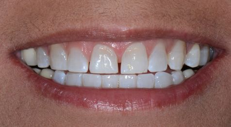 Before and After Dental Bonding - Before