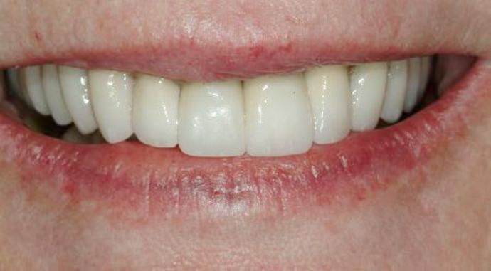 Dr. James Slaman's patient after reconstruction