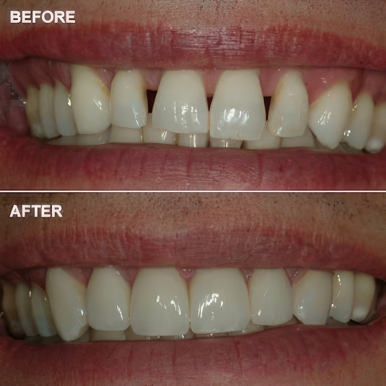 before and after of porcelain veneers