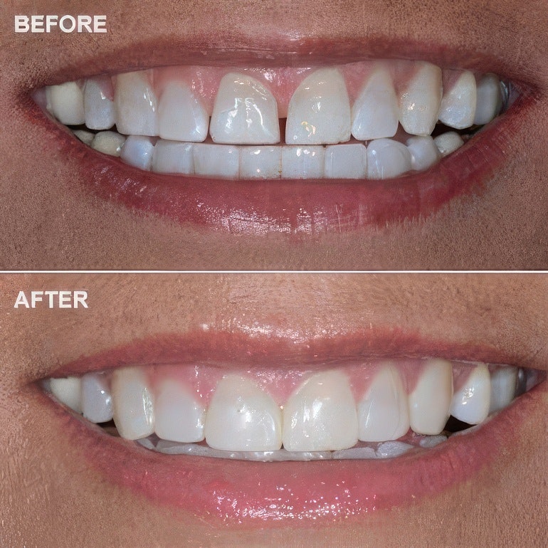 before image of dental bonding treatment on top after image showing no gaps in smile