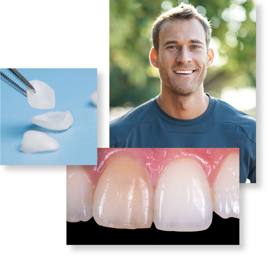 gallery image of veneers, discolored teeth and a young man smiling brightly