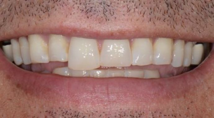 Dr. James Slaman's patient before smile makeover