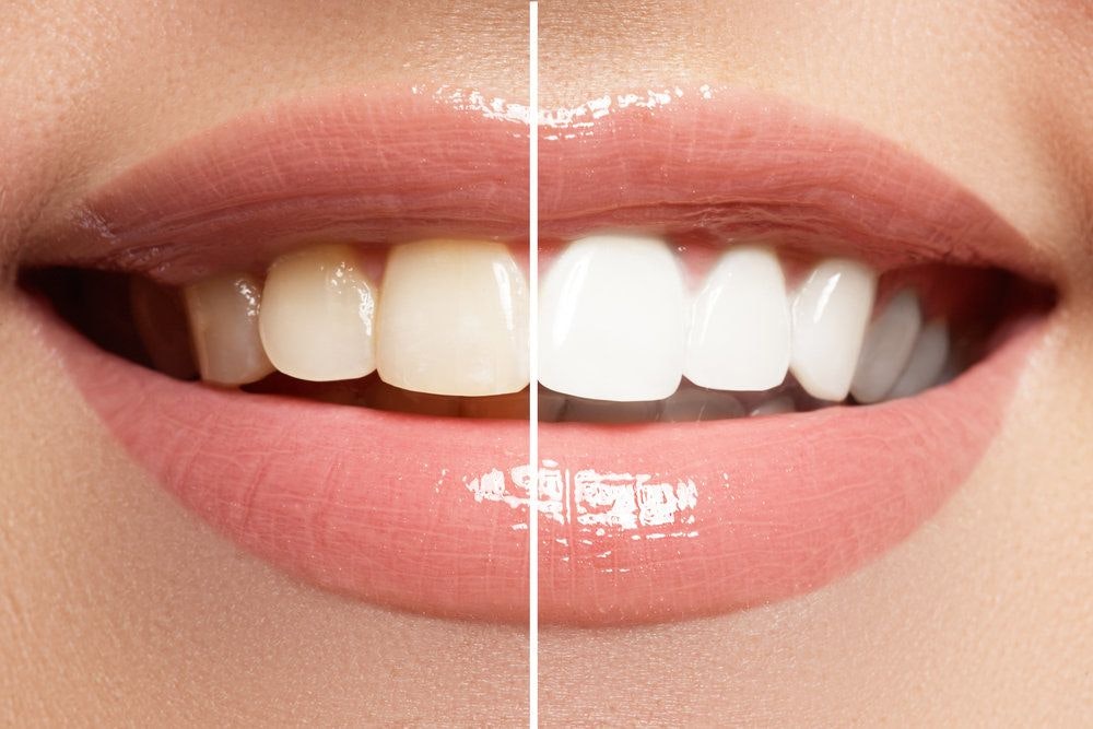 Close-up of teeth demonstrating the difference before and after a cosmetic dentistry teeth whitening procedure