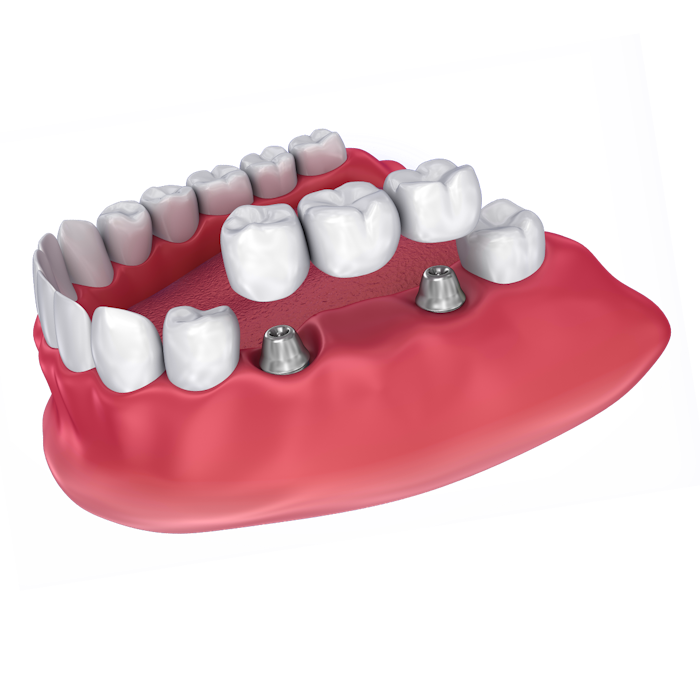 An illustration of a dental implant-supported bridge
