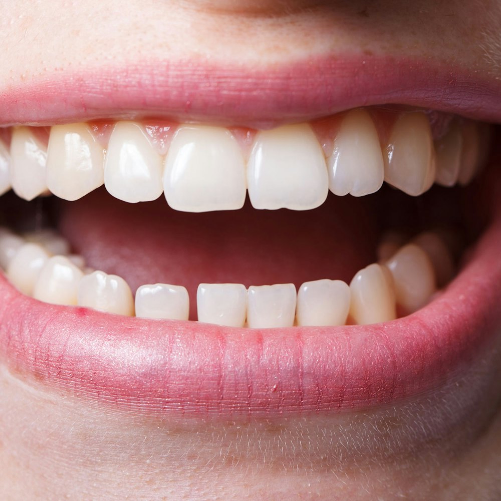 Close-up of chipped tooth before cosmetic dentistry procedure