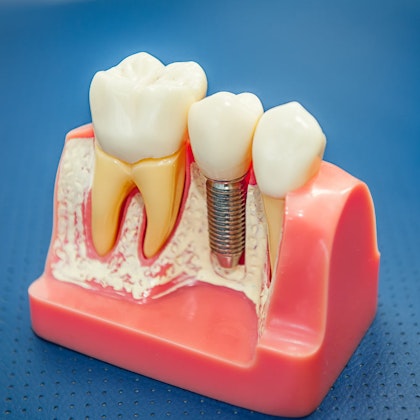 Model of implant crown
