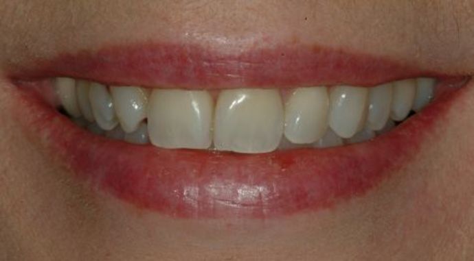 Veneers Case 1 - Before