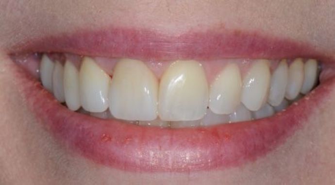 Veneers Case 1 - After
