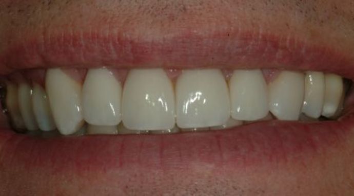 Veneers Case 2 - After