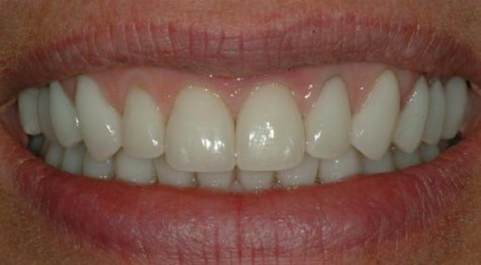 Smile Makeover Case 1 - After
