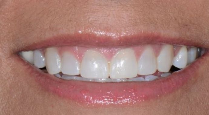 Bonding Case 2 - After